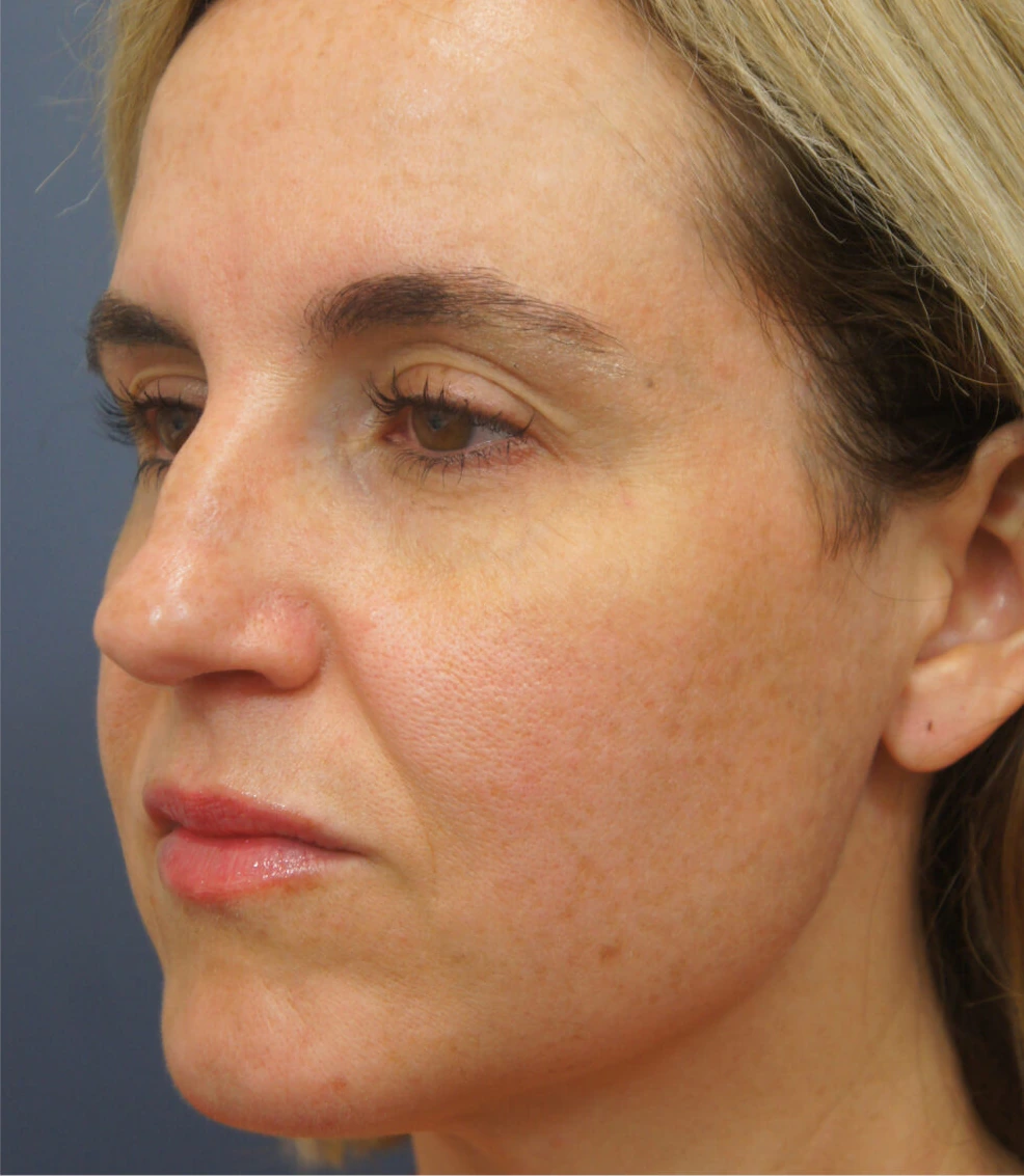 Face RF, illustrative after example
