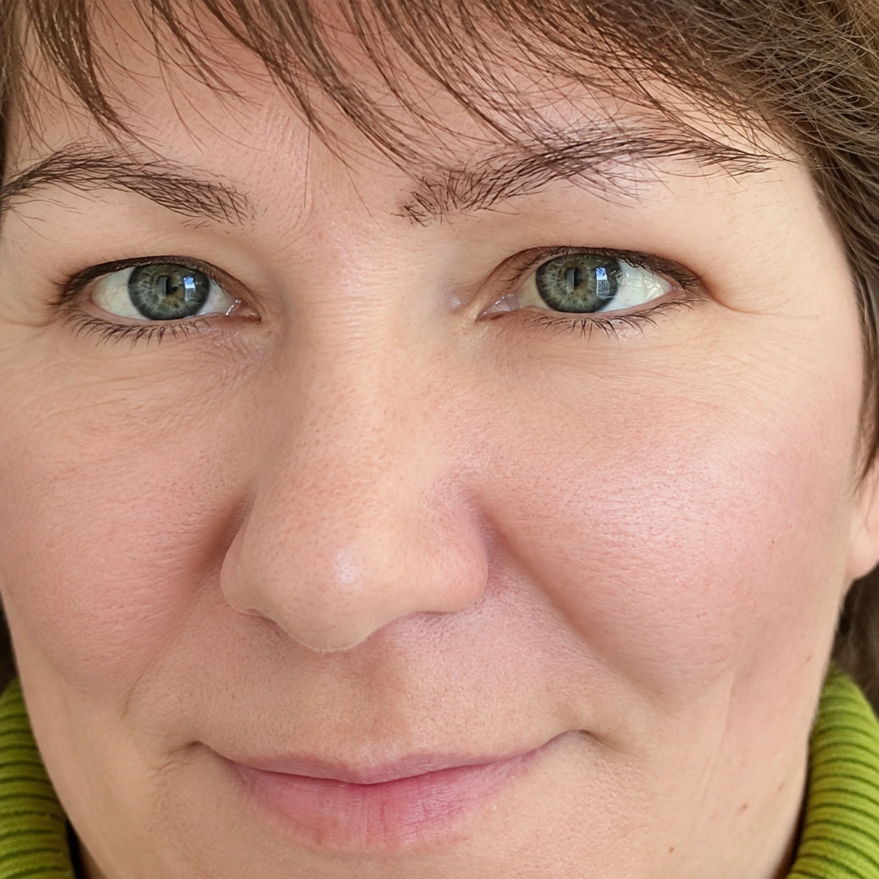 HIFU for Double-Chin Reduction, illustrative after example