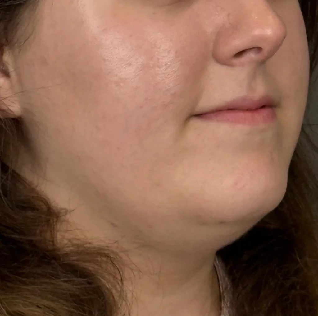 Hydration / HydraBoost Therapy, illustrative after example