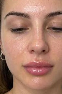 Hydrafacial, illustrative after example