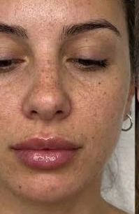 Hydrafacial, illustrative before example