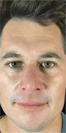 Photofacial, illustrative after example