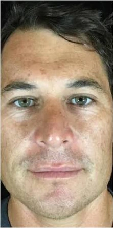 Photofacial, illustrative before example