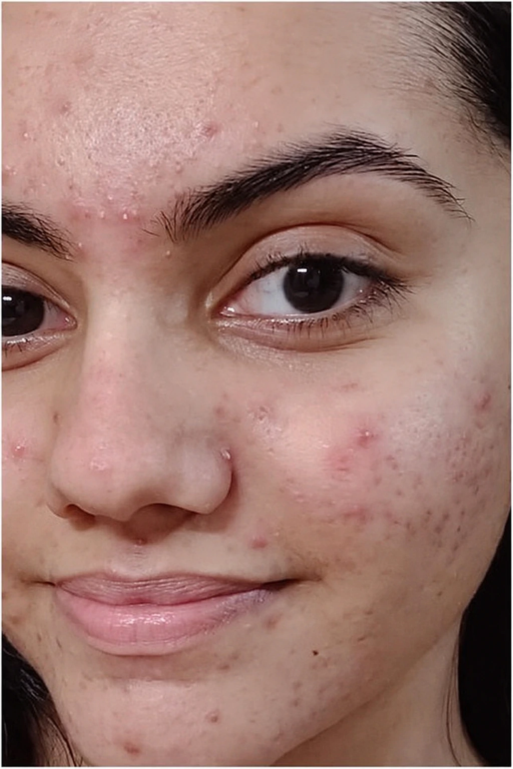 Power Hyaluronic Facial, illustrative before example