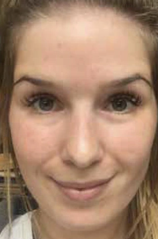 Power Oxygen Facial, illustrative after example