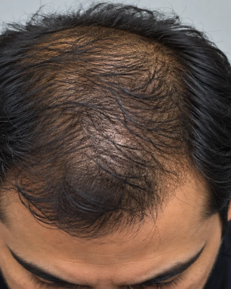 Scalp Threads, illustrative before example