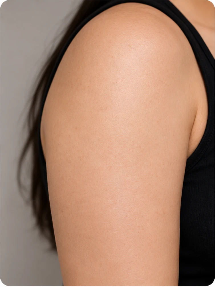 Tattoo Removal Treatment, illustrative after example