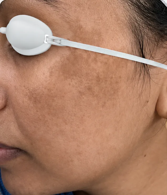 Cosmelan Peel — before treatment